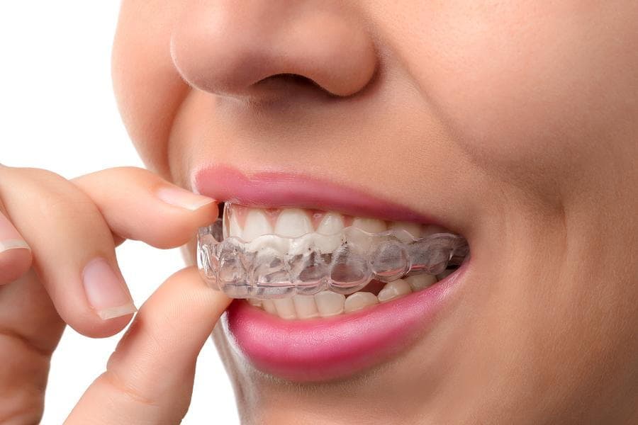 Clear Aligners Treatment at Avana Dental
