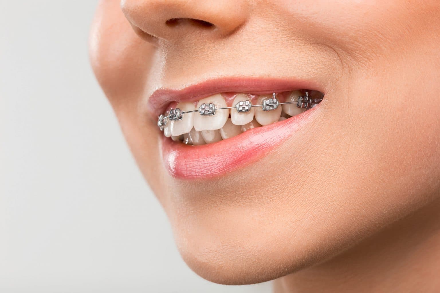 Dental Braces Treatment at Avana Dental