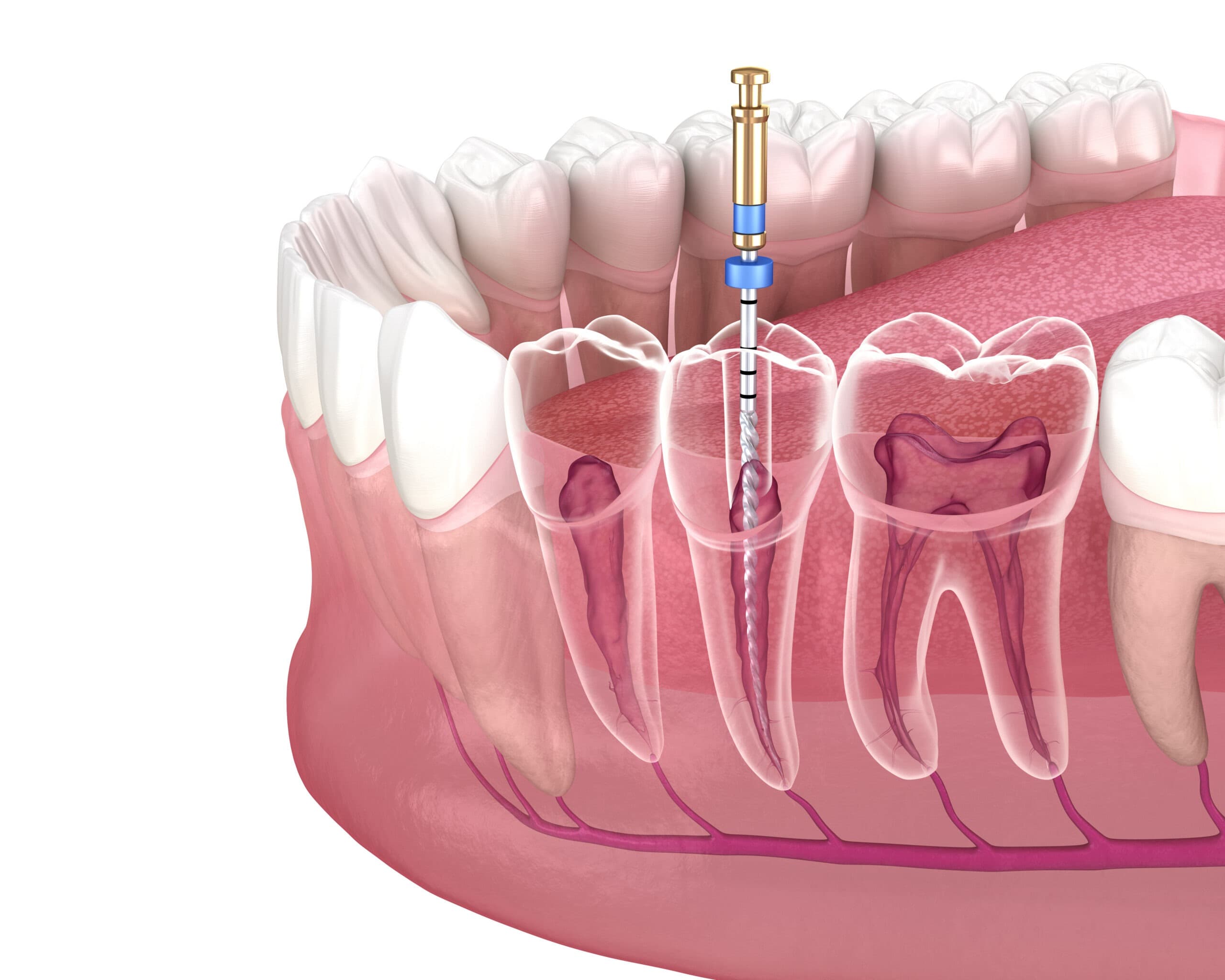Root Canal Treatment at Avana Dental