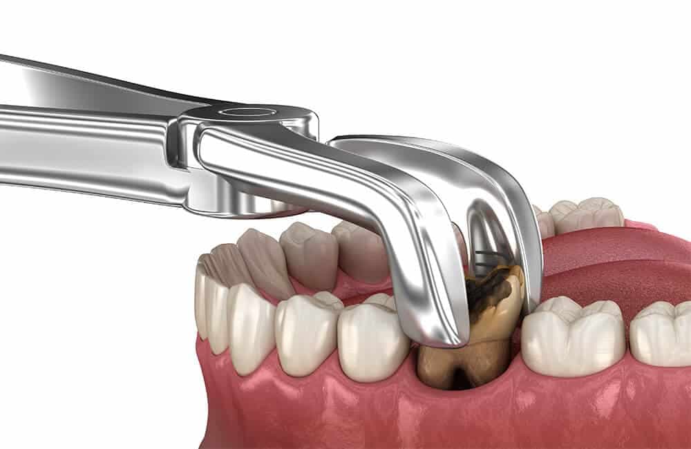 Tooth Extraction at Avana Dental