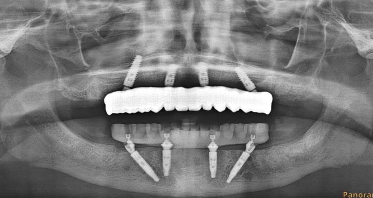 Multiple Tooth Dental Implant
