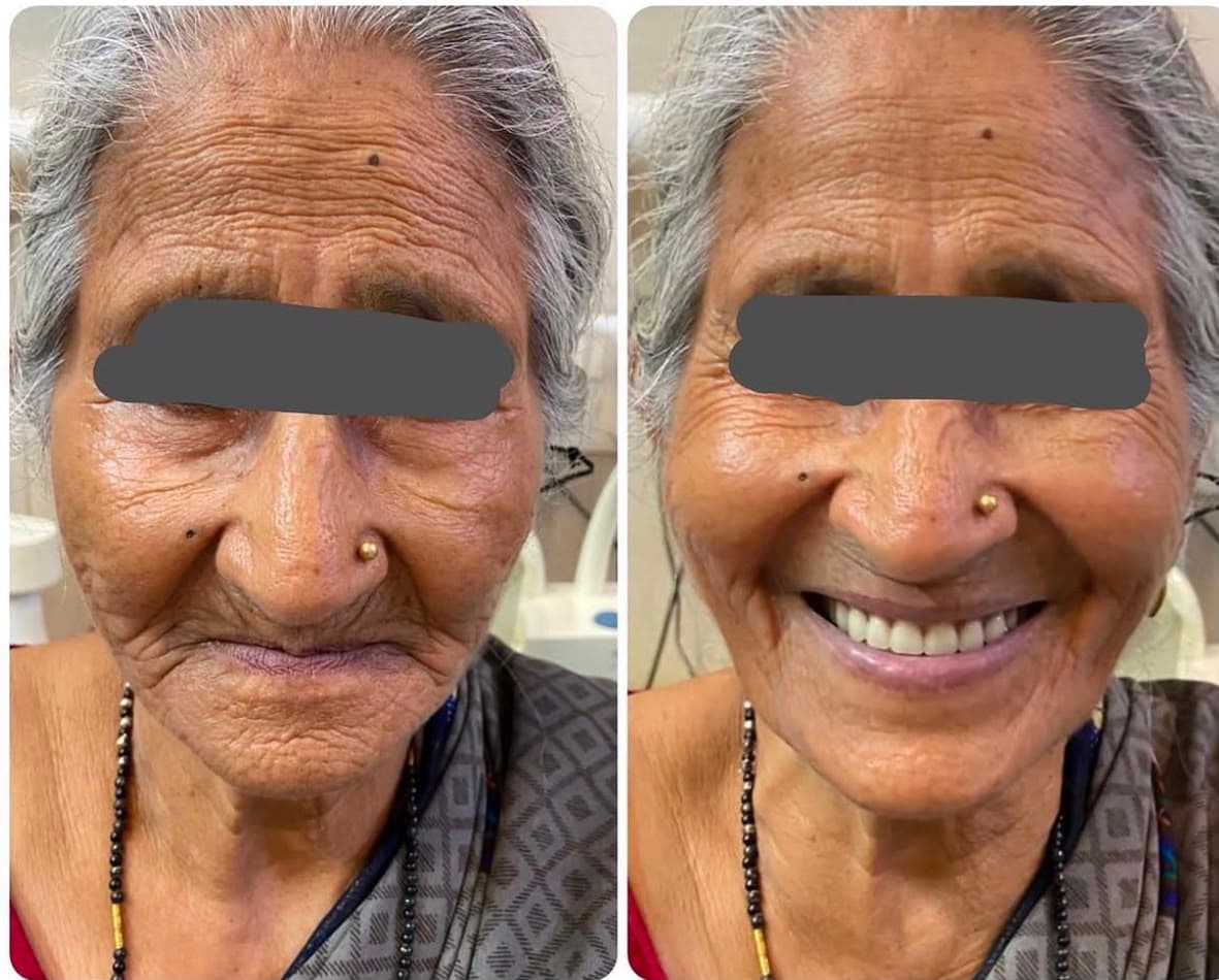 Full Mouth Rehabilitation with Dental Implants