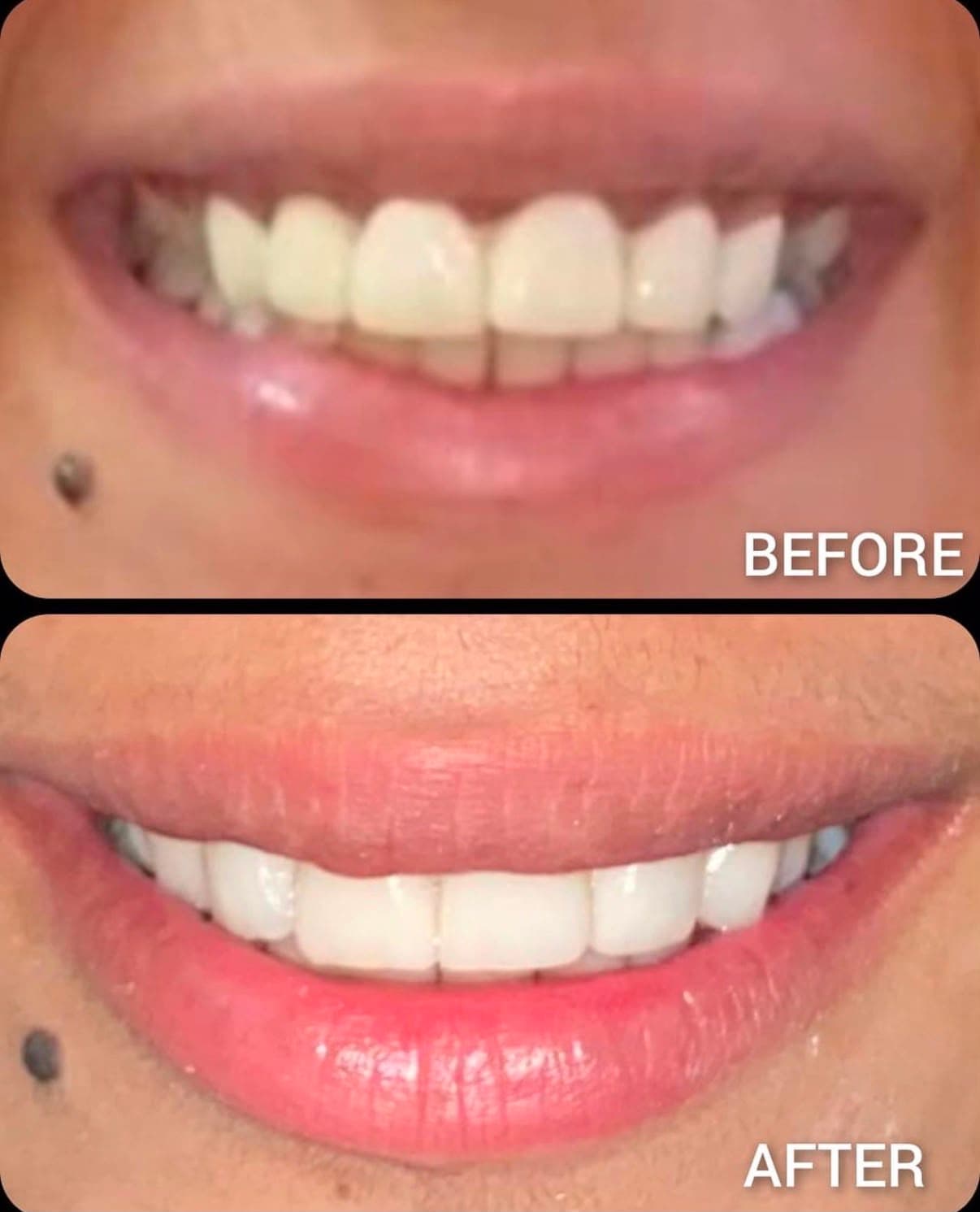 Smile Makeover with Porcelain Veneers