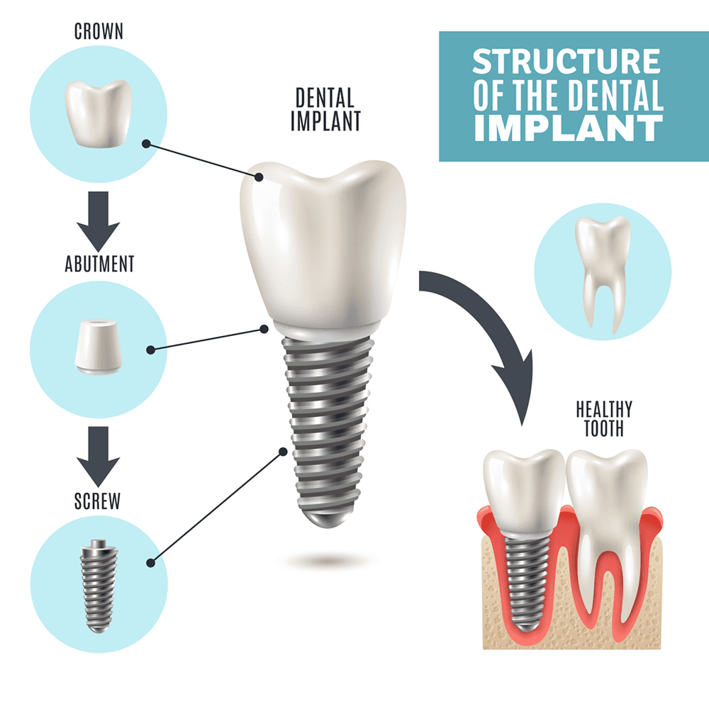 What Are Dental Implants