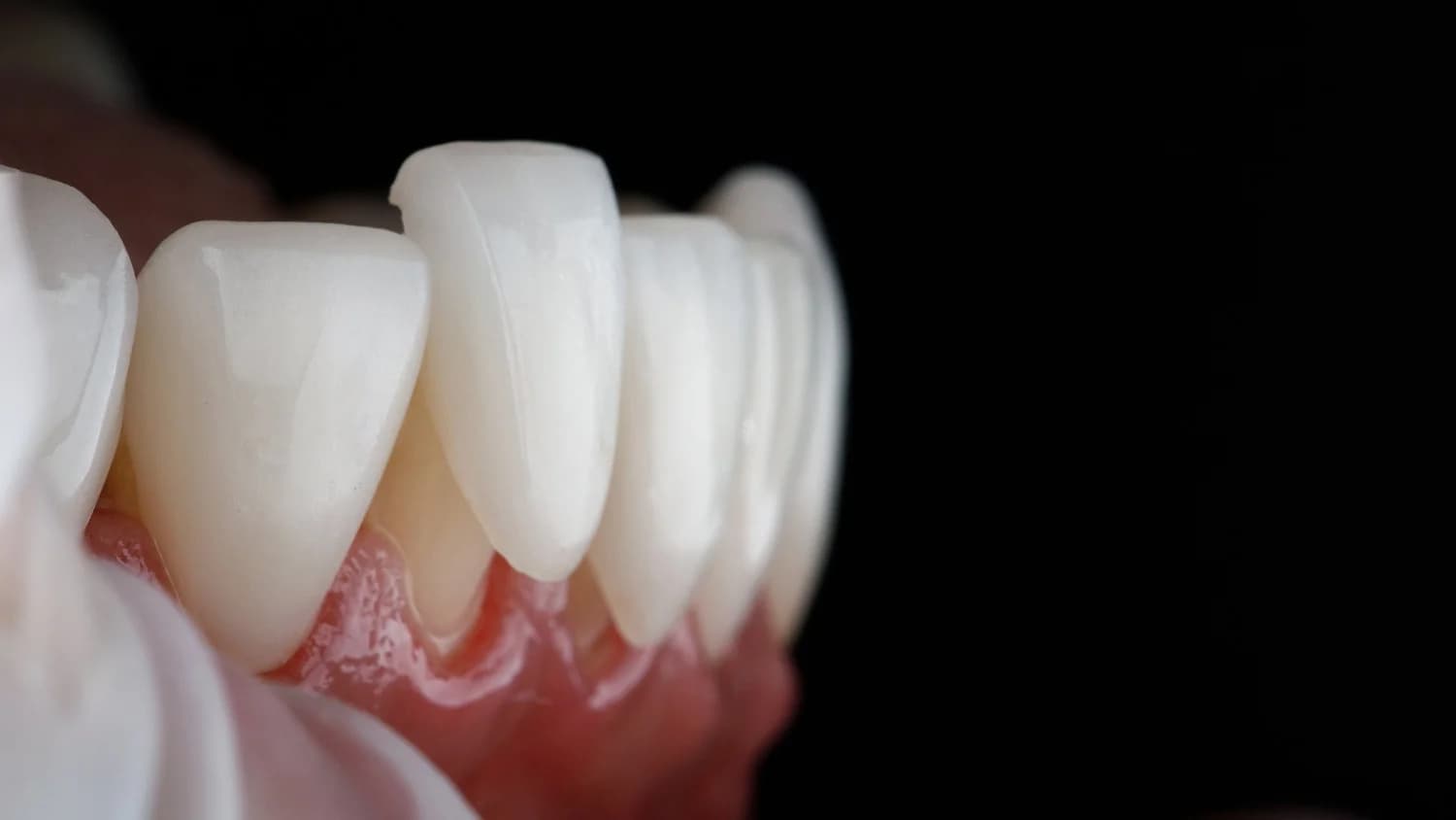 Smile Designing Results at Avana Dental Lucknow