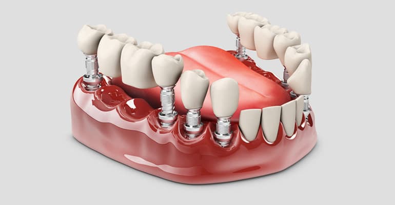 Benefits of Dental Crown and Bridge Treatment