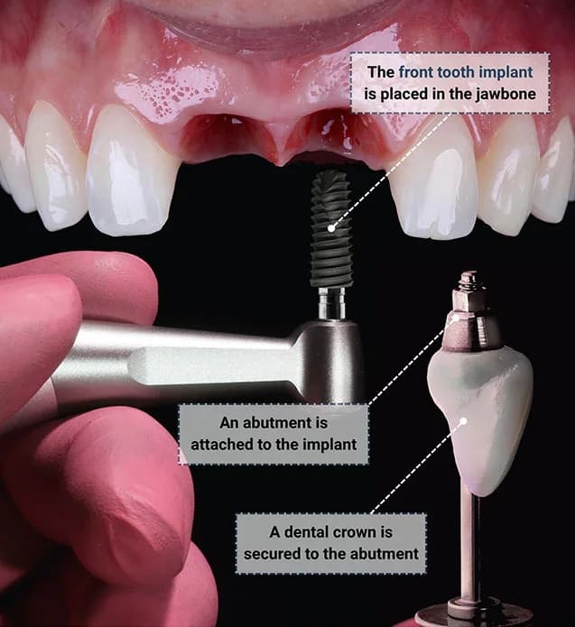 Why Dental Implants Are the Best Choice