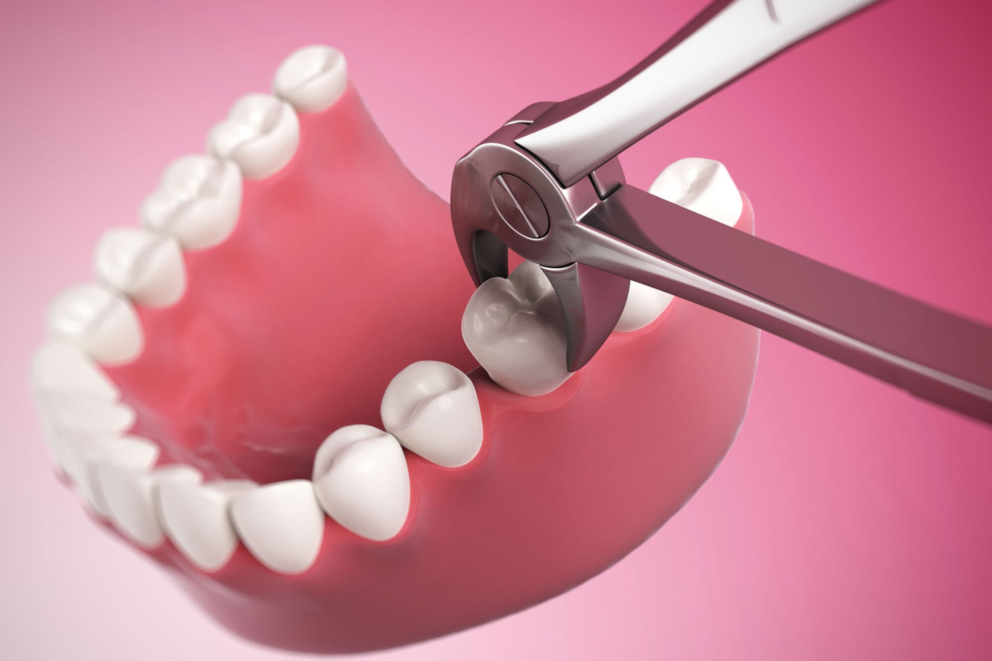 Benefits of Tooth Extraction at Avana Dental